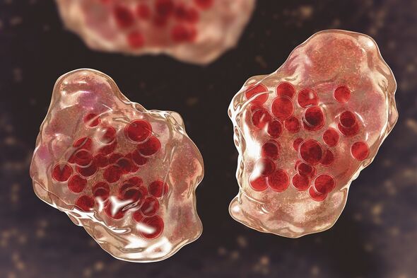 Una célula multinucleada gigante causada por el sarampión.