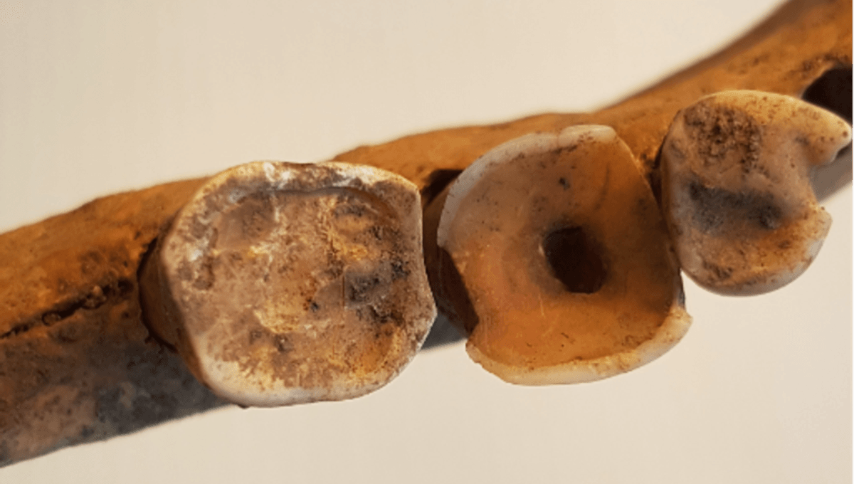 La odontología vikinga era "sorprendentemente avanzada", según un análisis de más de 3.000 dientes